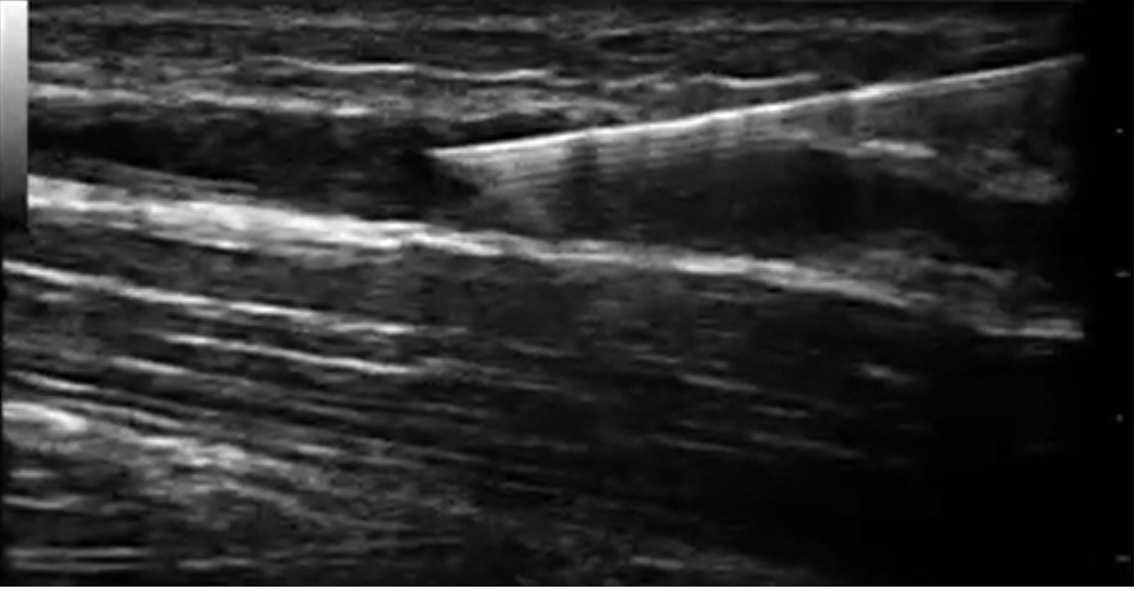 ESPUMA GUIADA POR ECOGRAFIA PARA VARICOSIDADES