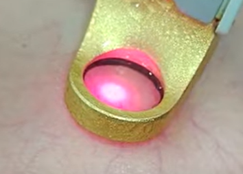 LASER PARA VENITAS EN CARA